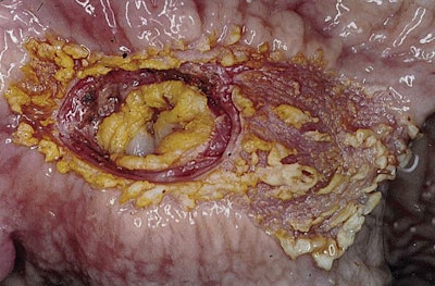 Pig Severe Ulcer Pars Oesophagea